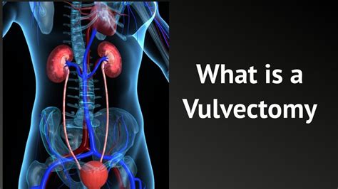 What Is A Vulvectomy Youtube