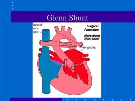 Ppt Congenital Heart Disease Powerpoint Presentation Id6369811