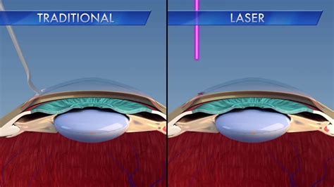 Laser Cataract Explainer Hd Youtube