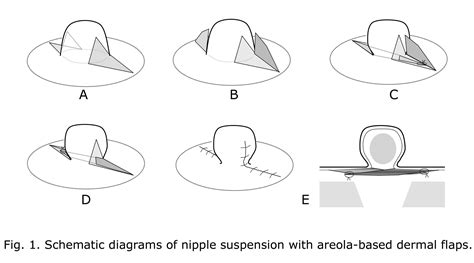 Correction Of Inverted Nipple Using Nipple Suspension With Areola Based Dermal Flaps