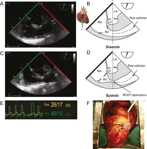 Right Ventricular Outflow Tract Obstruction In Adults A Systematic