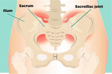 But this is very cleverly designed (engineers will understand so coming back to your question, what is the weakest bone in our body? well, i hope you have understood that our bones have 'strong' and. Sacroiliac (SI) Joint Pain: Understanding Causes, Symptoms ...