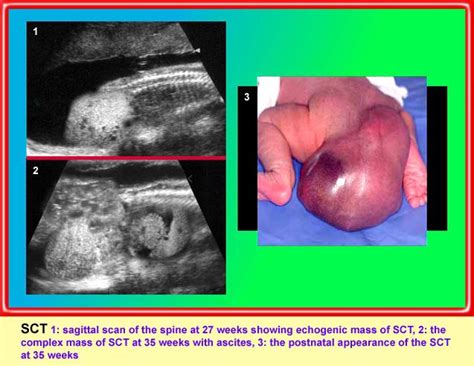 Ovarian Sex Cord Stromal Tumors Department Of Obstetrics And