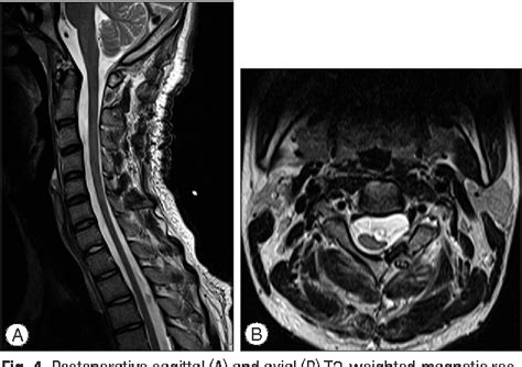 Figure 4 From Solitary Cervical Neurenteric Cyst In An Adolescent