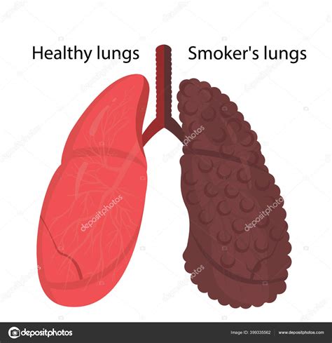 Fumadores Pulmones Y Pulmones Sanos Vector Gr Fico Vectorial