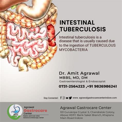 Intestinal Tuberculosis Symptoms Treatment Agrawal Gastrocare