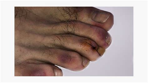 Are Sores On Your Feet A Symptom Of Covid 19