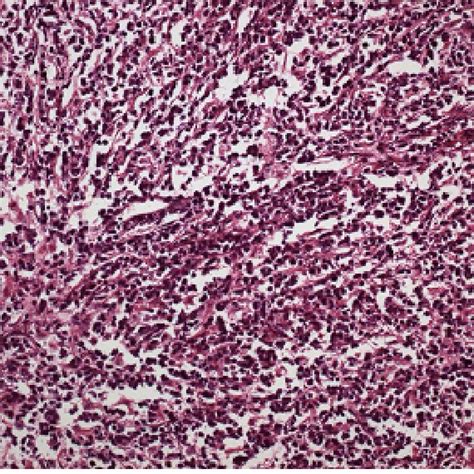 Malignant Lymphoma Of The Ovary Diffuse Distributions Of The Tumor