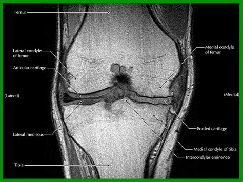 Knee And Hip Osteoarthritis Brace Access