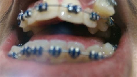 Dental Braces Frequently Asked Questions