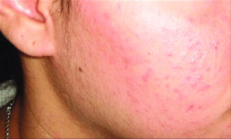 Grade I Mild Acne Showing Comedones With Few Inflammatory Papules And
