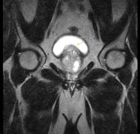 Benign Prostatic Hypertrophy Mri Sumers Radiology Blog