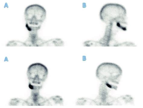 Bone Scintigraphy Of A Patient With Chronic Osteomyelitis Shows