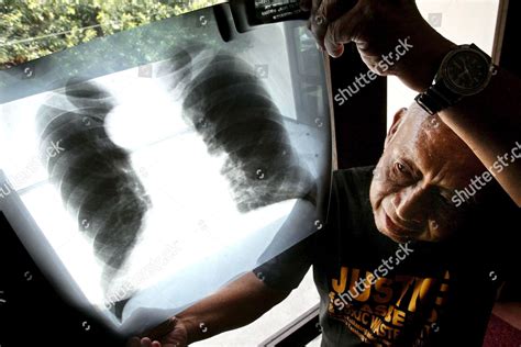 Seventyfiveyearold Asbestosis Patient Jose Reandino Who Editorial Stock