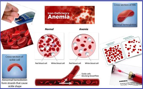 treatment for anemia homeopathic medicine for anemia treatment