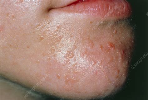 Common Warts On Boys Chin Stock Image M2900058 Science Photo