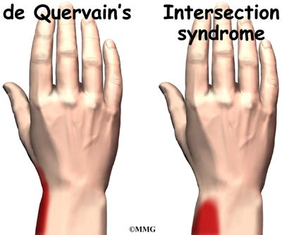 De quervain syndrome is inflammation of two tendons that control movement of the thumb and their tendon sheath. Wrist Intersection Syndrome