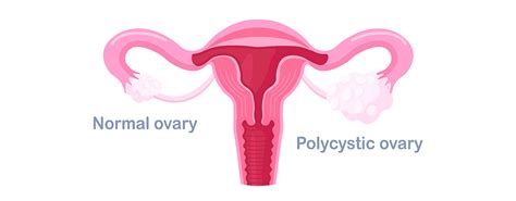 Polycystic Ovarian Syndrome PCOS GarbhaGudi