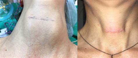 Post Operative Incisions And Scars Gallery Austin Thyroid Surgeons
