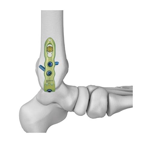 Md Distal Tibial Hook Locking Platemedical Device Manufacturers