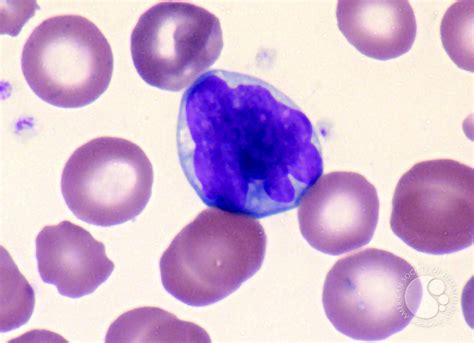 Adult T Cell Leukemialymphoma 4