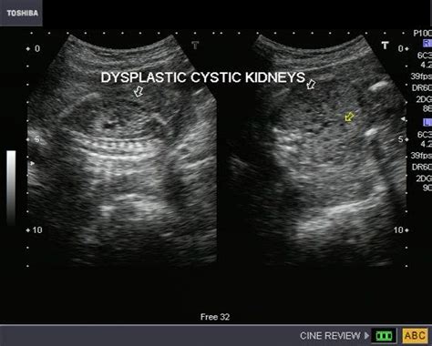 Cochinblogs Sonography Of Fetal Kidneys With Autosomal Recessive