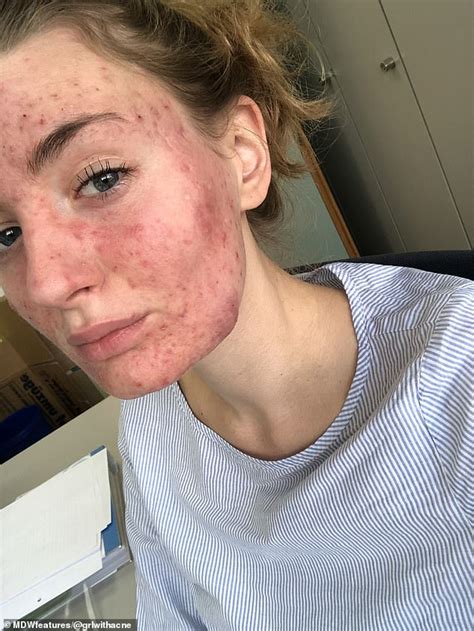 Woman Who Had Cystic Acne So Severe That It Affected Her Sight Readsector