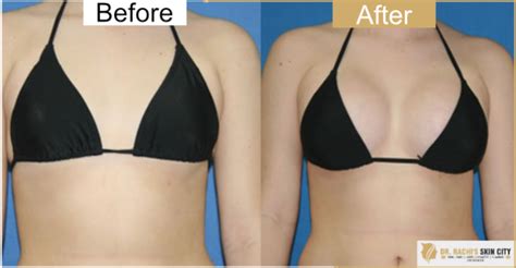 Breast Lift Without Surgery Core Plastic Surgery