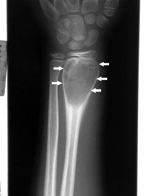 Image Aneurysmal Bone Cyst Of The Wrist Msd Manual Professional Edition