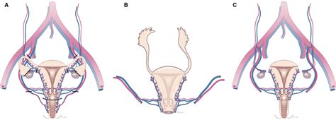 Diagrammatic Representation Of A Uterine Transplant Retrieval Download Scientific Diagram