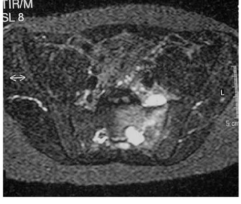 A Mr Image Shows An Osteosarcoma Of The Sacrum With Extension Into The