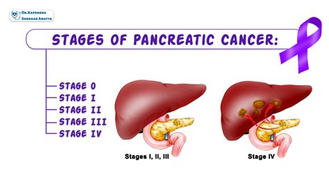 Pancreatic Cancer Dr Kapendra Shekhar Amatya