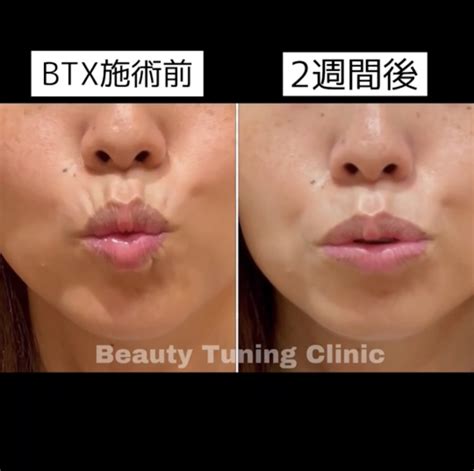 【動画あり】唇の上の縦ジワへのボトックス Beauty Tuning Clinic
