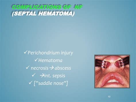 Ppt Nasal Fractures Powerpoint Presentation Free Download Id4502153