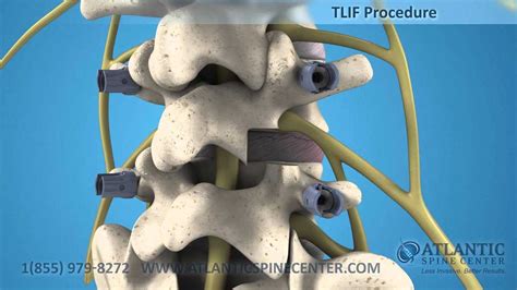 Mini Invasive Transforaminal Lumbar Interbody Fusion Mini Tlif Atlantic Spine Center