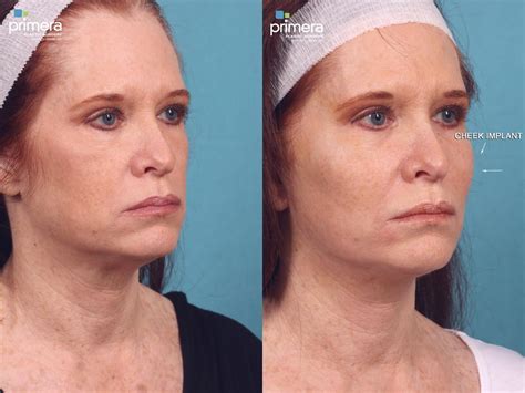 Chin And Cheek Implant Before And After Photos Patient 417 Orlando