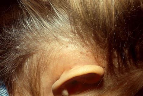 What Does Lice Look Like Photos Info On Head Body Pubic Lice