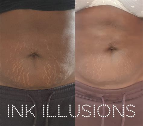 What Is The Inkless Stretch Mark Removal Camouflage Treatment Ink Illusions