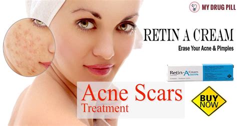 Erase Your Acne And Pimples Red Marks Using Retin A Creambit