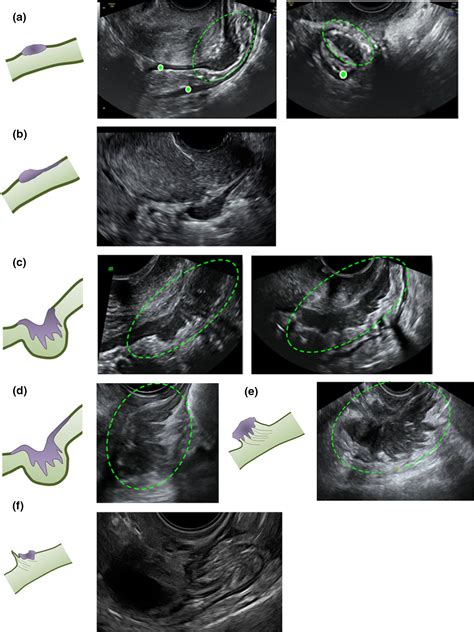 How To Perform An Ultrasound To Diagnose Endometriosis Leonardi