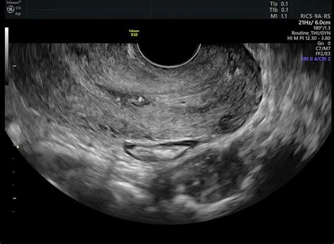 Can Cervical Cancer Be Seen On Ultrasound Cancerwalls