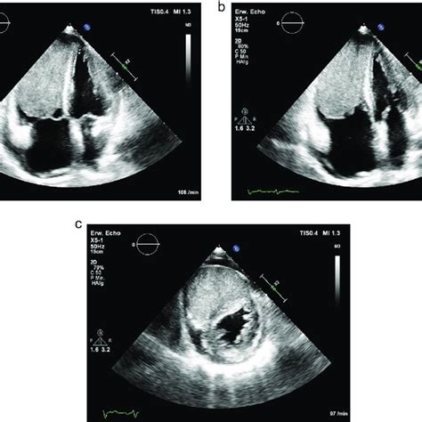 The Apical 4 Chamber View In Transthoracic Echocardiography Tte Shows Download Scientific
