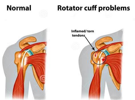 Subacromial Impingement Syndrome Pain And Weakness Of The Arm And The