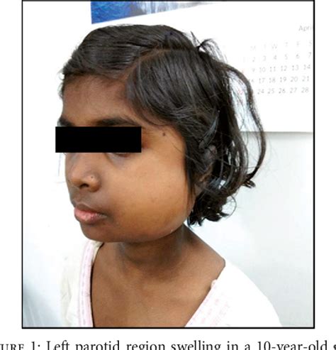 Figure 1 From A Rare Case Of Parotid Gland Tuberculosis Semantic Scholar