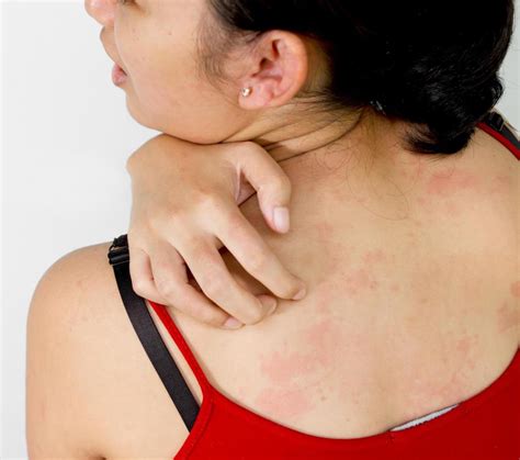 What Causes A Back Rash With Pictures