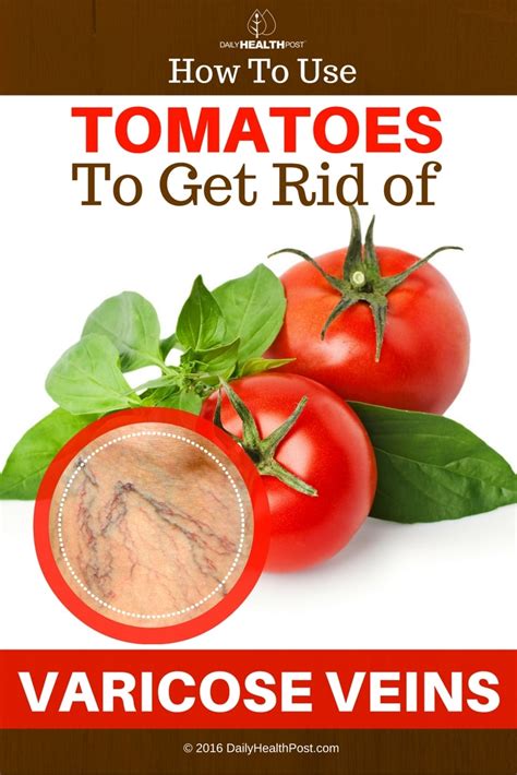 How To Use Tomatoes To Get Rid Of Varicose Veins