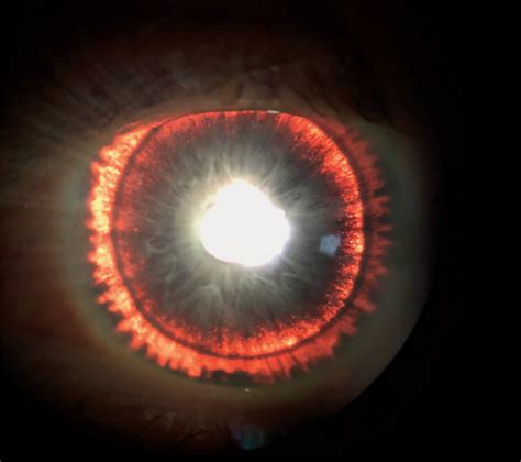 Mans Glowing Iris Was A Sign Of Rare Eye Syndrome Live Science