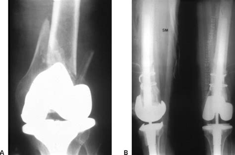 Fracture Above Total Knee Arthroplasty Femur Musculoskeletal Key