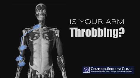 Your Arm Throbbing Might Not Be An Arm Problem Centeno Schultz Clinic