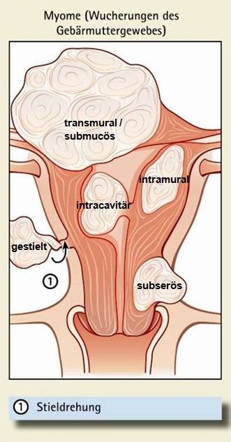 Leiomyom des uterus, myom des uterus, uterus myomatosus, gebärmuttermyom das myom der gebärmutter ist in der regel nicht gefährlich, aber es kann die lebensqualität der. IVF-Saar - Myome